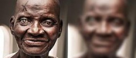 Eye health and cataracts