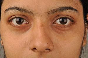 Eye health - Bags under eyes