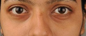 Eye health - Bags under eyes
