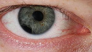 Eye health - eye lesions
