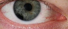 Eye health - eye lesions