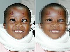 Eye health for children