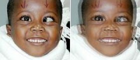 Eye health for children