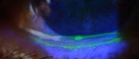 Eye infections and injuries