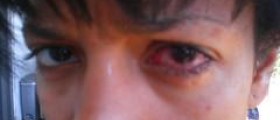 Eye infections in adults