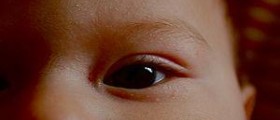 Eye infections in babies