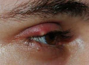 Eye stye symptoms and causes