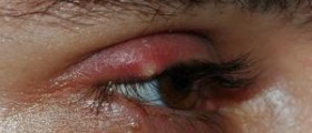 Eye stye symptoms and causes
