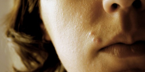 Acne Scars Treatment Options