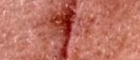 Facial scar removal