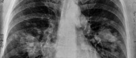 Facts about adenocarcinoma lung cancer