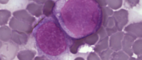 Facts about leukemia