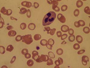 Fanconi anemia - At the crossroads of DNA repair