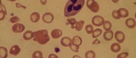 Fanconi anemia - At the crossroads of DNA repair