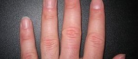 Fingernail health facts