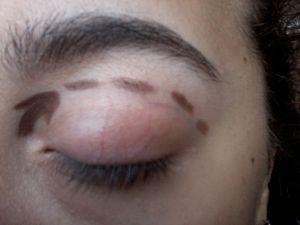 First signs of eyelid problems