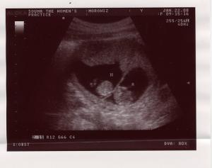 First signs of twin pregnancy