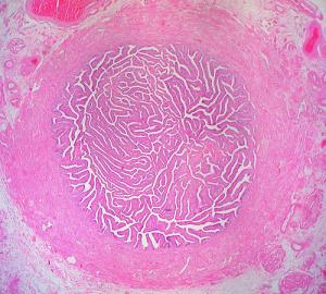 Fixing blocked fallopian tubes