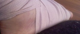 Lisfranc Fracture – Commonly Missed Diagnosis