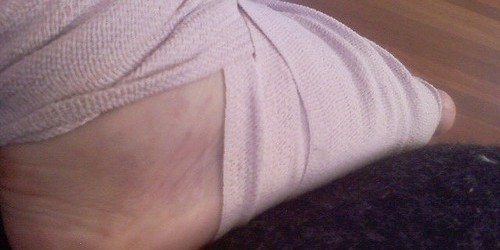 Lisfranc Fracture – Commonly Missed Diagnosis