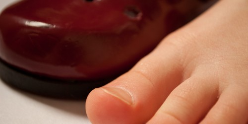 Mortons Neuroma: Symptoms and Treatment of Plantar Neuroma