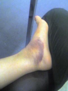 Foot and ankle injuries