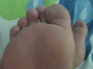 Foot corn removal