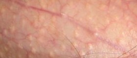 Fordyce's spots treatment