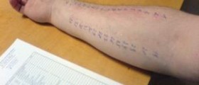 Formaldehyde allergy symptoms