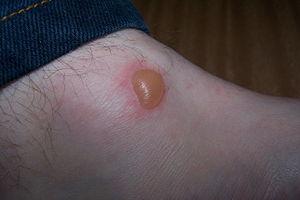 Frequently asked questions about fever blisters