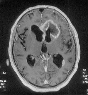 Frontal lobe epilepsy: Seizures of the brain