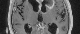 Frontal lobe epilepsy: Seizures of the brain
