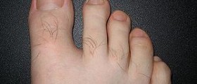 Full detailed information on ingrown toenails