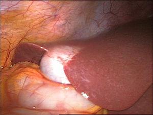 Gallbladder surgery recovery time