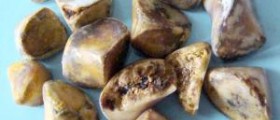 Gallstone diet- naturally treat and prevent gallstones with your diet