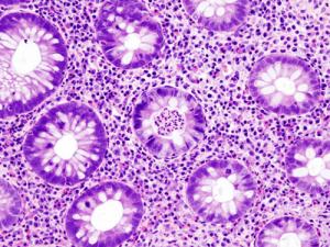 Gastric ulcer pain