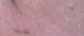 Genital Warts: Prevention, Diagnosis And Treatment