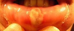 Get rid of canker sore