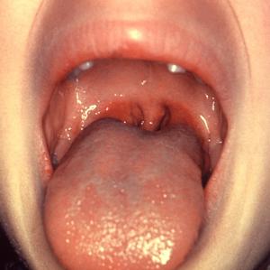 Get rid of tonsil stones