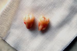 Getting wisdom teeth pulled