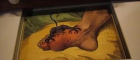 Gout remedies and causes