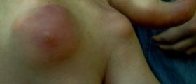 Gout remedies and vital information - restore your health today
