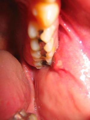 Gum disease and infection