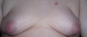 Gynecomastia surgery cost