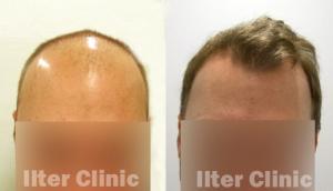 Hair transplant recovery