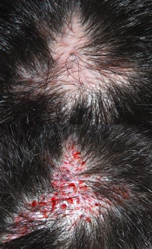 Hair transplant surgery cost