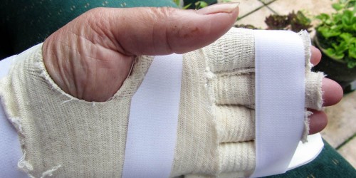 Hand Splints May Ease Pain for People Suffering Degenerative Arthritis