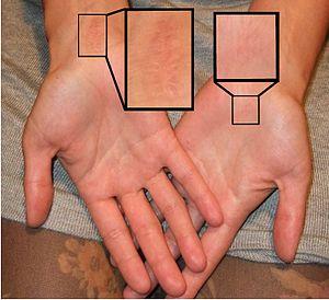 Hand surgery: Carpal tunnel syndrome