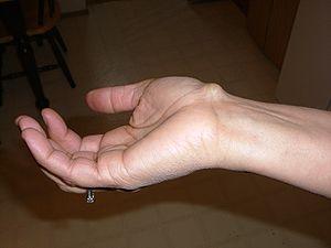 Hand surgery for ganglion cyst
