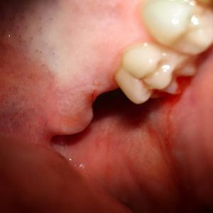 Handling painful tooth